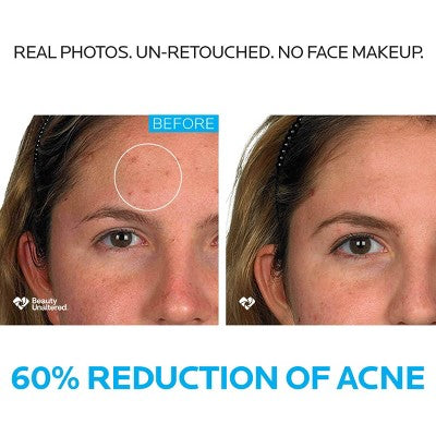 La Roche-Posay Effaclar 3-Step Acne Treatment System Kit