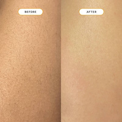 Nood Ingrown Hair Treatment The Eraser