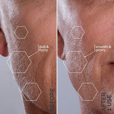 Spa Sciences SIMA Deluxe Sonic Dermaplaning Tool for Exfoliation & Peach Fuzz Removal