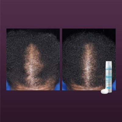 Women’s Rogaine 5% Minoxidil Foam for Hair Thinning and Regrowth 2.11oz