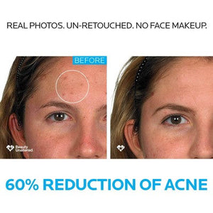 La Roche-Posay Effaclar 3-Step Acne Treatment System Kit