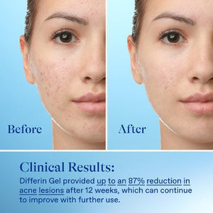 Differin Acne Retinoid Face and Body Treatment Gel Adapalene 0.1% 15g - Imperfect Box