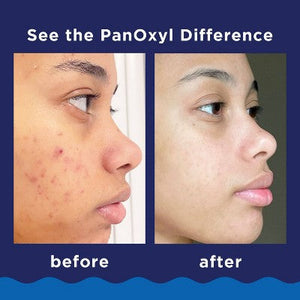 PanOxyl 10% Benzoyl Peroxide Acne Foaming Wash 5.5oz - Missing Box