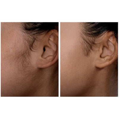 Spa Sciences SIMA Deluxe Sonic Dermaplaning Tool for Exfoliation & Peach Fuzz Removal