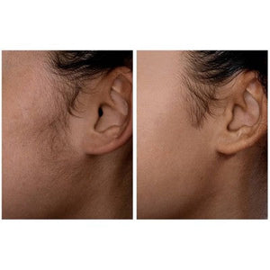 Spa Sciences SIMA Deluxe Sonic Dermaplaning Tool for Exfoliation & Peach Fuzz Removal