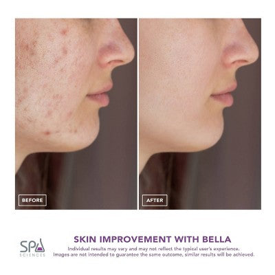 Spa Sciences BELLA 3-in-1 Diamond Tip Microdermabrasion System
