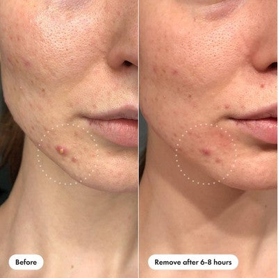 Hero Cosmetics Mighty Patch Invisible Acne Pimple Patches 39ct