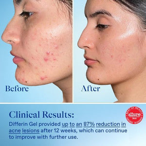 Differin Acne Retinoid Face and Body Treatment Gel Adapalene 0.1% 15g - Imperfect Box