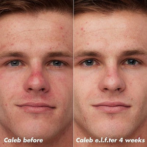 e.l.f. SKIN PLZ Clarify Facial Oil 2% Salicylic Acid Acne Treatment + Aloe Extract 1 fl oz - Imperfect Box
